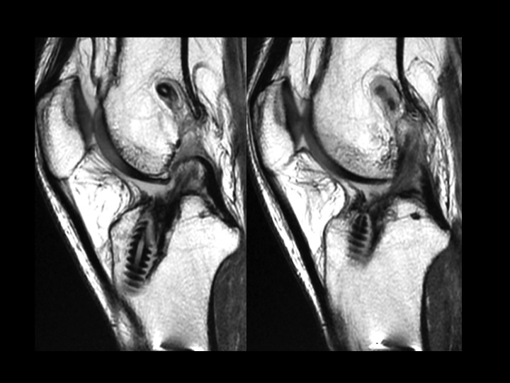 Figure 4 for case ACL graft device ( RID5523 )